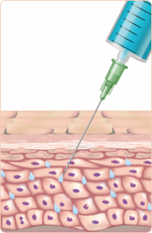 Infusion
