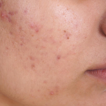 Pimples