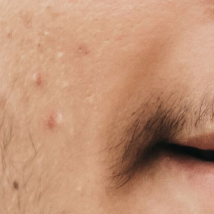 Pimples