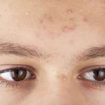 Pimples