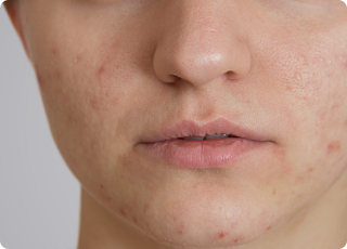 Acne