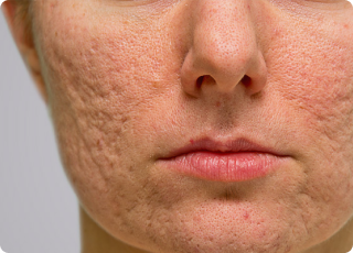 Acne Scars
