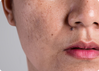 Age Spots