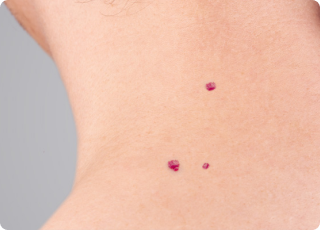 Blood Spots