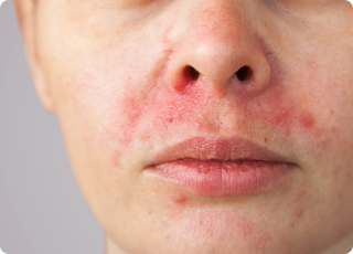 Perioral Dermatitis