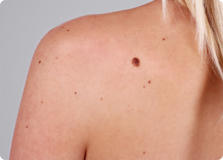 Moles