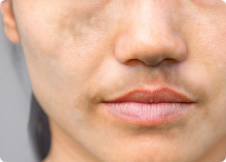 Pigmentation Skin