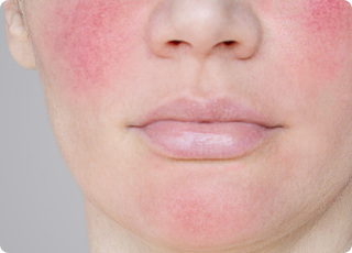 Rosacea