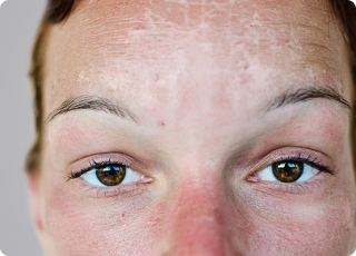 Pigmentation Skin