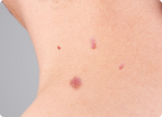Skin tags