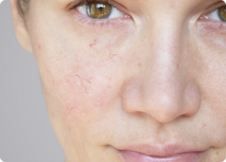 Surface Blood Vessels