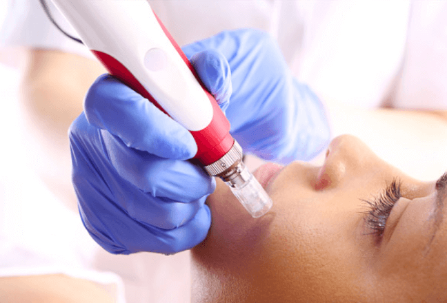 Acne Scar Treatment