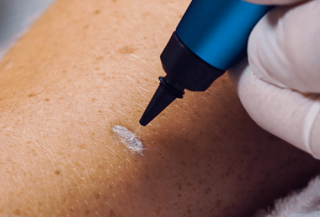 CryoPen