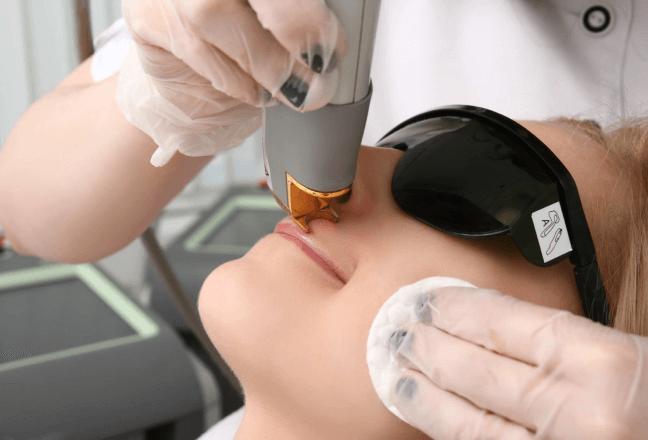 IPL Pigmentation