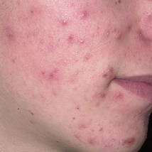 Pimples