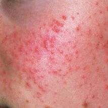 Pimples