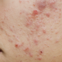 Pimples